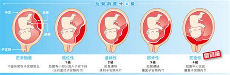 完全性前置胎盤